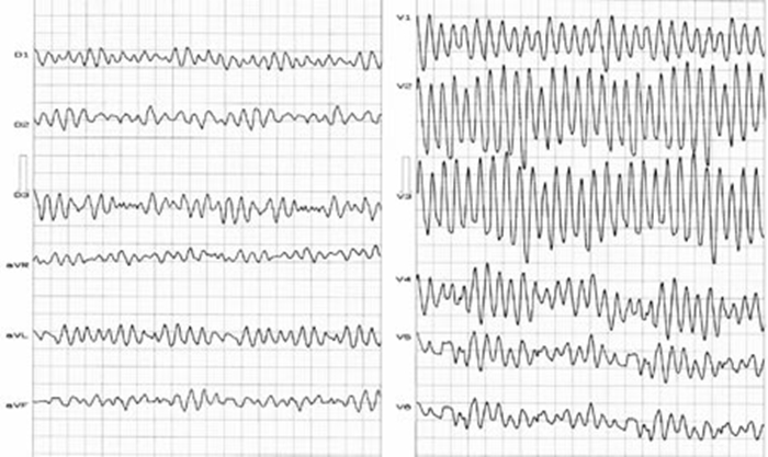 Fibrilace komor EKG Medicína nemoci studium na 1 LF UK