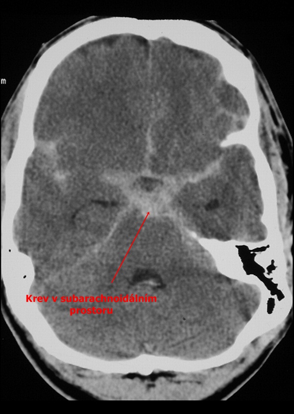 Subarachoidální krvácení CT Medicína nemoci studium na 1 LF UK
