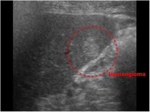 Splenic hemangioma - sonography