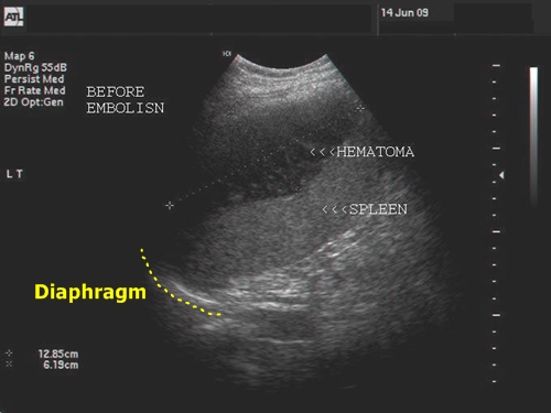 Splenic hematoma - sonography