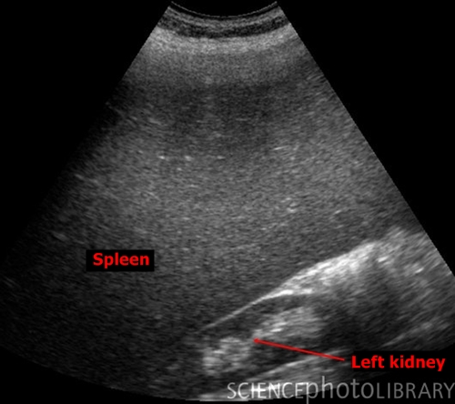 Splenomegaly - sonography